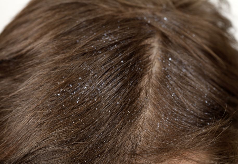 8. Understanding the Life Cycle of Head Lice in Blonde Hair - wide 2